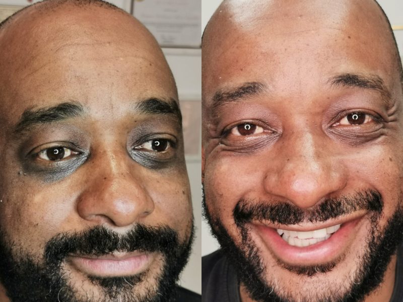 ojeras piel negra (1)